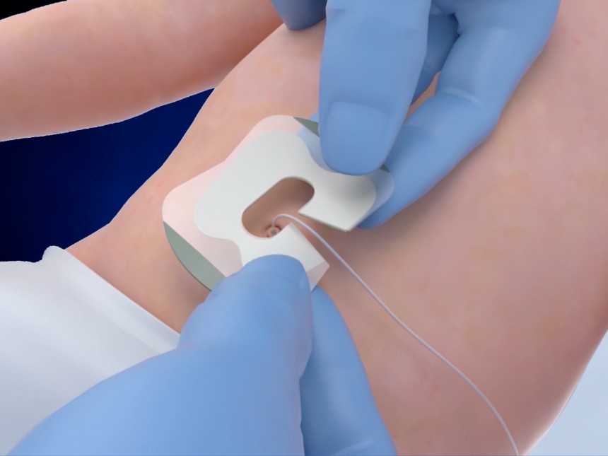 Neotech Neogrip Neotech NeoBridge® Umbilical Catheter Holder - Henleys Medical Supplies