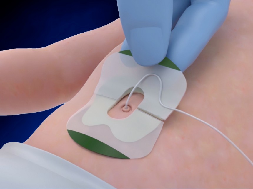 NeoBridge Umbilical Catheter Holder