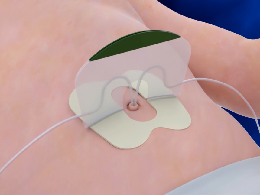 Neotech Neogrip Neotech NeoBridge® Umbilical Catheter Holder - Henleys Medical Supplies