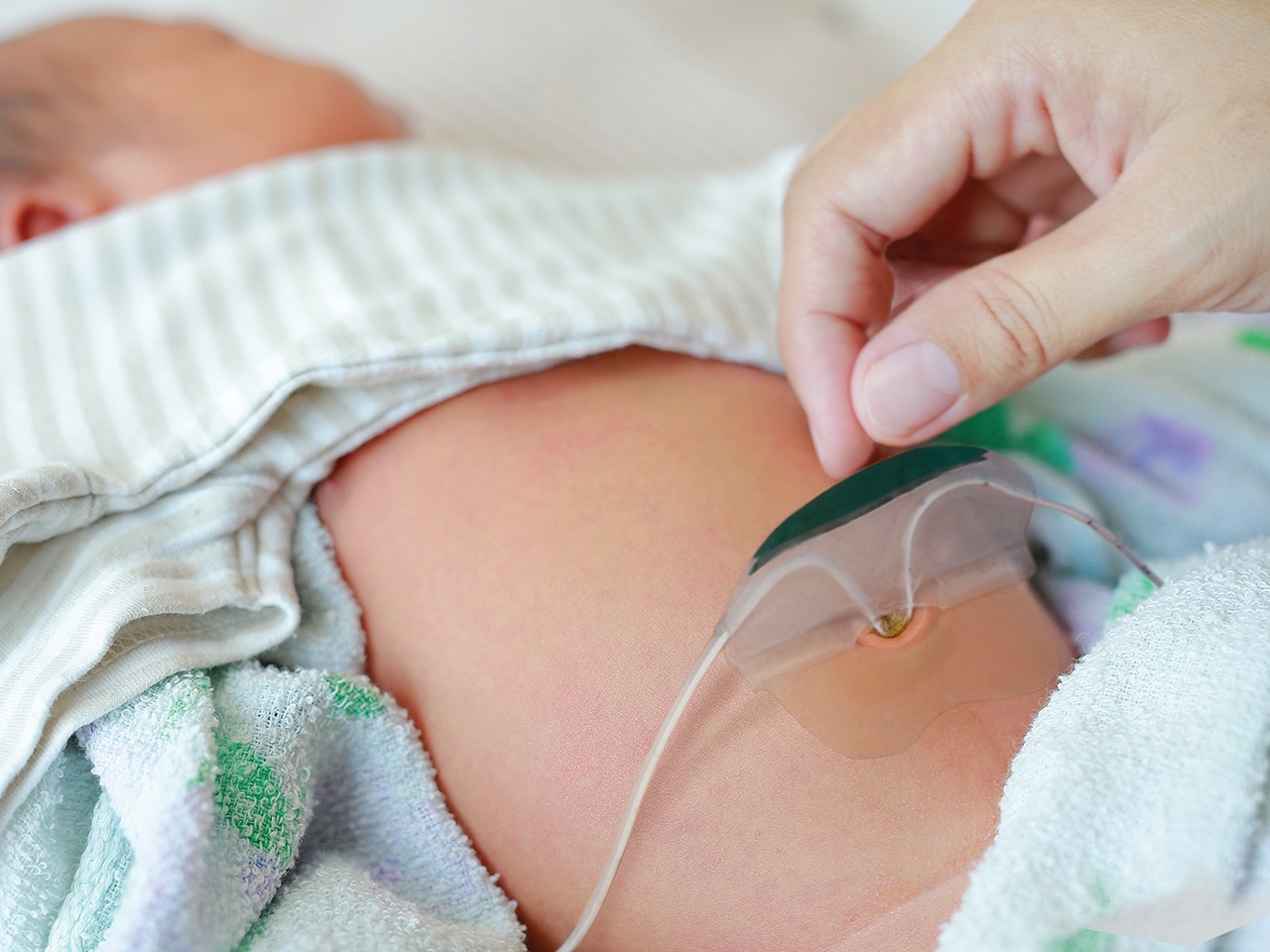 Neotech Neogrip Neotech NeoBridge® Umbilical Catheter Holder - Henleys Medical Supplies